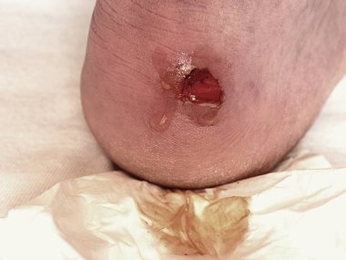 Craced korkunç blister insan topuk üzerinde. Adam ayak kanlı acı cilt.