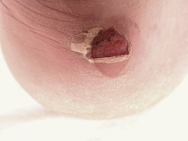 Craced korkunç blister insan topuk üzerinde. Adam ayak kanlı acı cilt.