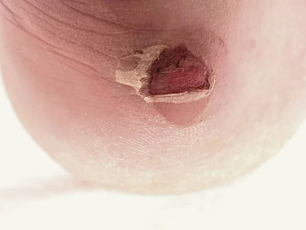 Craced bolha terrível no calcanhar humano. Maldita pele dolorosa no pé do homem . — Fotografia de Stock