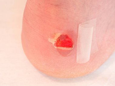 Topuk bandaj ile yara. Adam ayak yapıştırıcı sıva ile kanlı acı cilt ıslak