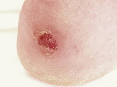 Craced korkunç blister insan topuk üzerinde. Adam ayak kanlı acı cilt.