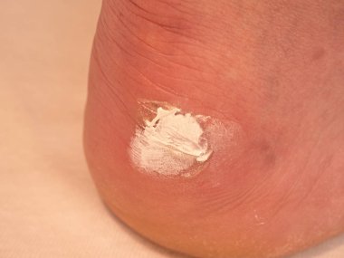 Kanlı ve ıslak yırtık deri ile acı bir yer deri saçları ile yara. Şifa merhem beyaz ile tedavi