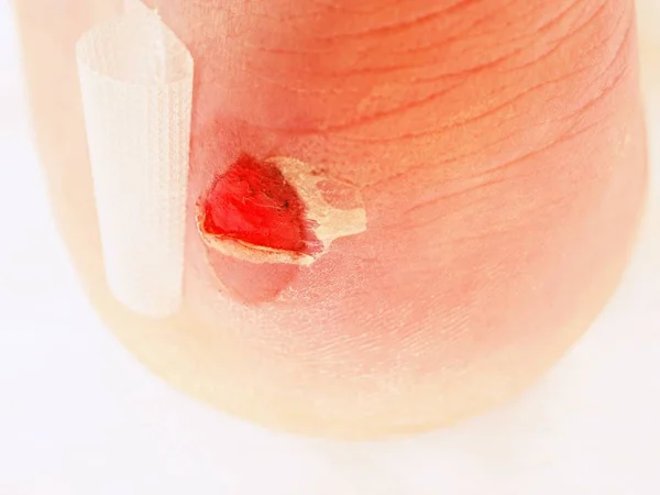 П'ята рана з пов'язкою. Мокра кривава болюча шкіра на нозі людини з клейкою штукатуркою — стокове фото
