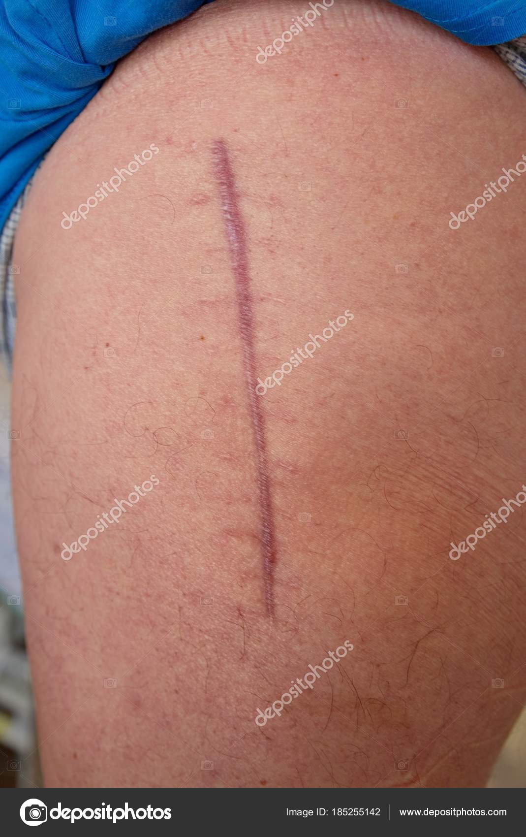 One Year Old Scar Surgery Hip Joint Replacing Devastated Hip Stock