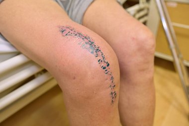 Çok acı verici diz eklem kaza veya artrit tarafından etkilenen kaldırma