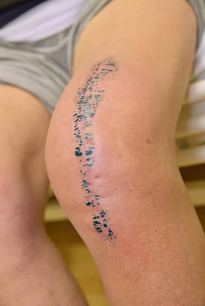 Extracción de la articulación de la rodilla muy dolorosa afectada por accidente o artritis —  Fotos de Stock