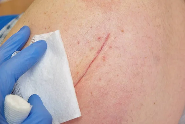 Пациент со свежим длинным шрамом на бедре лежал в больнице плохо. Медсестра руки очистить кожу . — стоковое фото