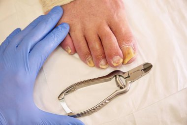 Ayak tırnakları mantarlar. Nasır ile ayak ayak parmakları bükülmüş. Hallux rigidus 