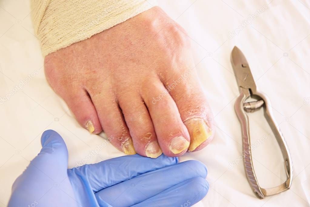 Fungus on the toes nails. Twisted toes on the foot with calluses.  Hallux rigidus 