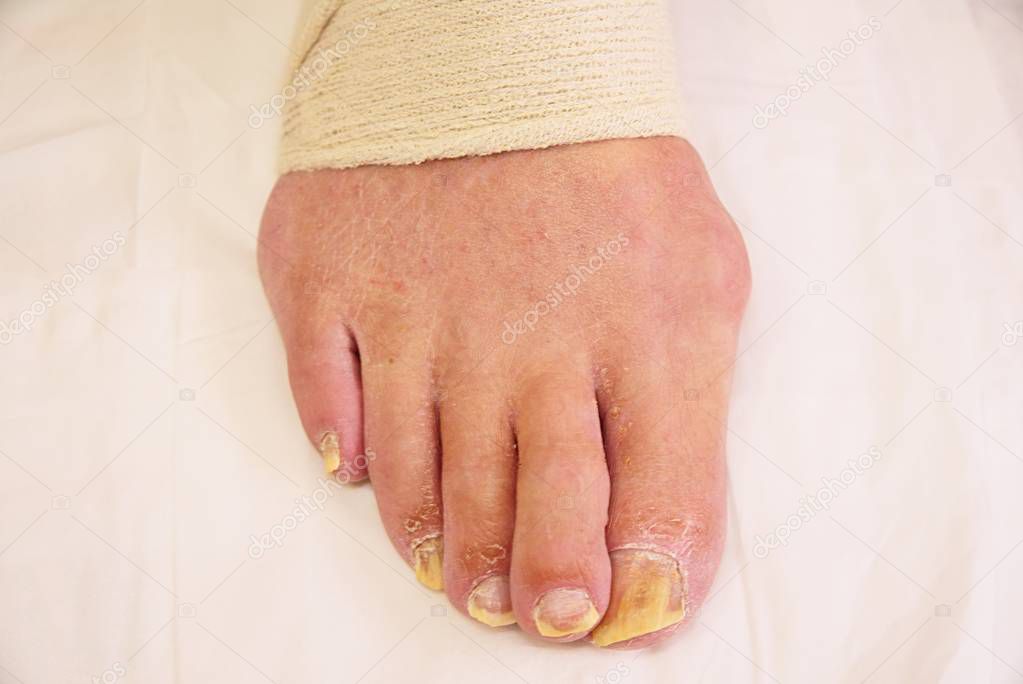 Bad foot skin bacterial fungal infection with damaged nail close up.  