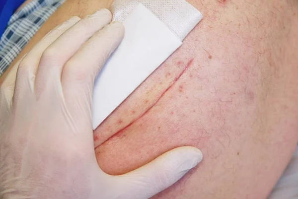 Cicatrisation profonde images libres de droit, photos de Cicatrisation