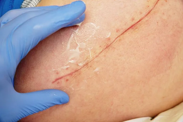 Frische Narbe nach chirurgischer Operation einer 65-jährigen Patientin. langer tiefer Schnitt am Körper — Stockfoto