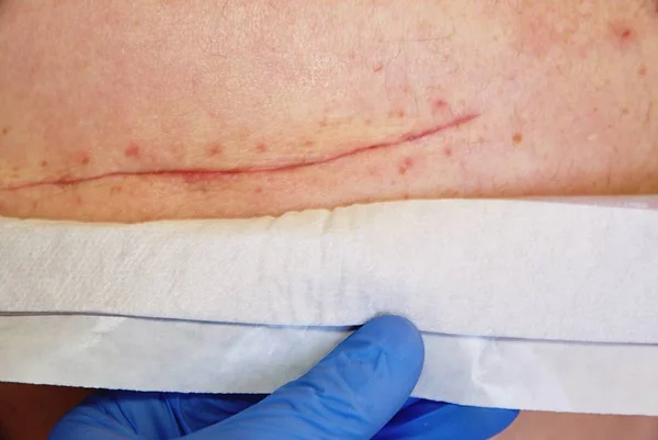 Fresh scar after  surgical surgery of 65 years old patient.  Long deep cut on the body