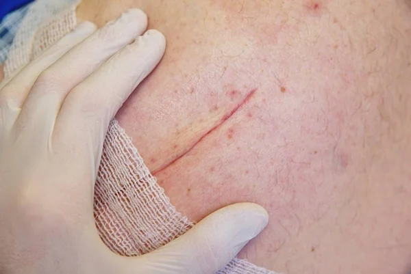 Fresh scar after  surgical surgery of 65 years old patient.  Long deep cut on the body