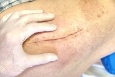 Eski insan bacak Kalça eklemi cerrahisi ameliyat sonrası yara izi ile. Erkek vücudunun seçici odak.