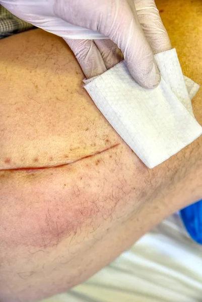 Patient month after surgery, long scar on hip. Control of healing, clear the skin.