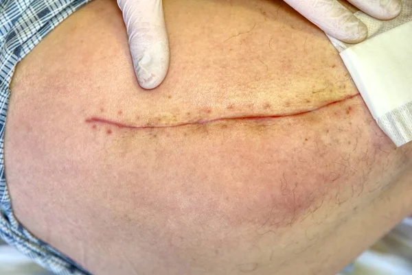 Patient month after surgery, long scar on hip. Control of healing, clear the skin.