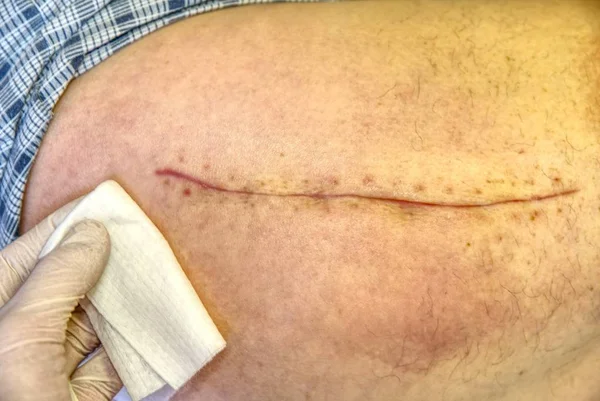 Perna humana velha com cicatriz pós-operatória de cirurgia da articulação do quadril. Foco seletivo do corpo masculino . — Fotografia de Stock