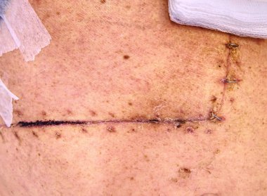 Fresh postoperative scar sewn with silver thread clipart