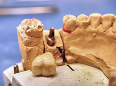 Diş implantı modeli ve iğne ve diş implantı. Diş Modeli 