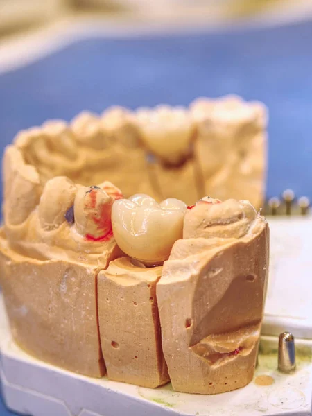 Próteses dentárias em semiprocesso. Gesso Mandíbulas estomatológicas — Fotografia de Stock