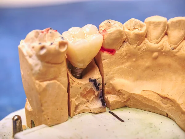 Keramik- und Zirkoniumkronen menschlicher Zähne auf einem Modell — Stockfoto