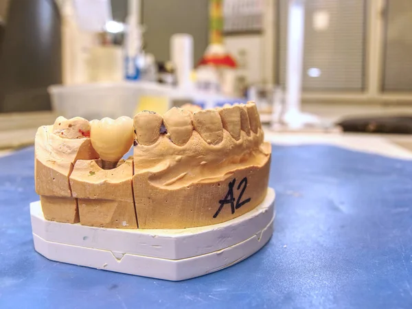 Proteza stomatologiczna w półprocesie. Badanie sztucznego zęba — Zdjęcie stockowe