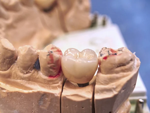Model zubního implantátu s jehlicí a zubním implantátem. Zubní model — Stock fotografie