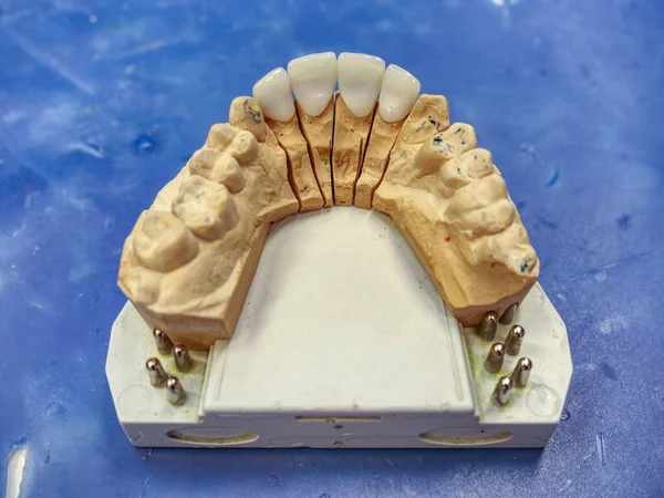 Diş Hekimi Diş Teknisyeni Ağzınıza Kısmi Takma Diş Yerleştirmek Için — Stok fotoğraf