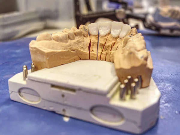 Ceramiczna Wysokoestetyczna Korona Dentystyczna Modelu Gipsowym Firmy Labotary — Zdjęcie stockowe