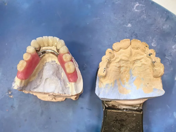 Zahnimplantation Gipskiefer Mit Keramikprothesen Und Metallprothesen Moderne Stomatologie — Stockfoto