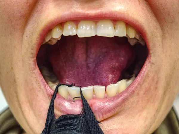 Mulher Boca Aberta Com Tira Tecido Mostrou Seus Dentes Tortos — Fotografia de Stock