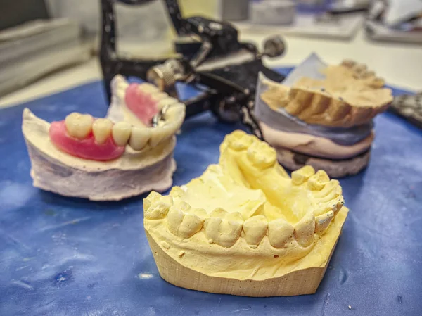 Ceramic dental implants on gypsum layout. Plaster cast stomatologic human jaws prothetic laboratory