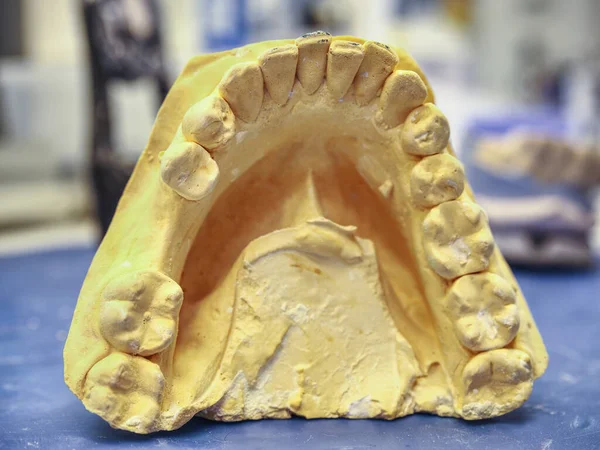 作業台上の人工歯のアライメント用の石膏モデル — ストック写真