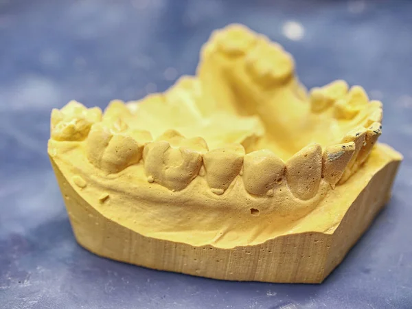 歯石膏モデル 歯科医療の概念 3Dモデルに入れ歯を装着した人間の歯 — ストック写真