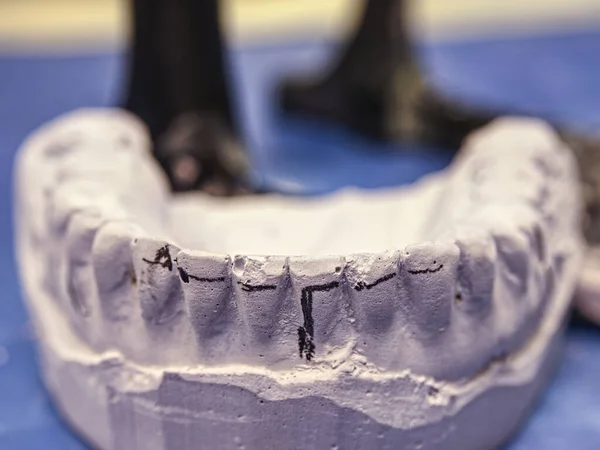 Modelo Para Técnico Odontológico Articulador Mandíbula Gesso Com Prótese Cerâmica — Fotografia de Stock