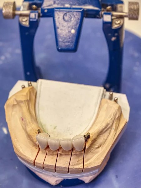 Implante Dentário Estomatologia Mandíbula Com Próteses Cerâmicas Próteses Metálicas — Fotografia de Stock