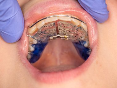 Diş telli dişler dişçi resepsiyonunda. Yakın plan. Eldivenin içinde hastaların dişlerine takılan bir alet var..