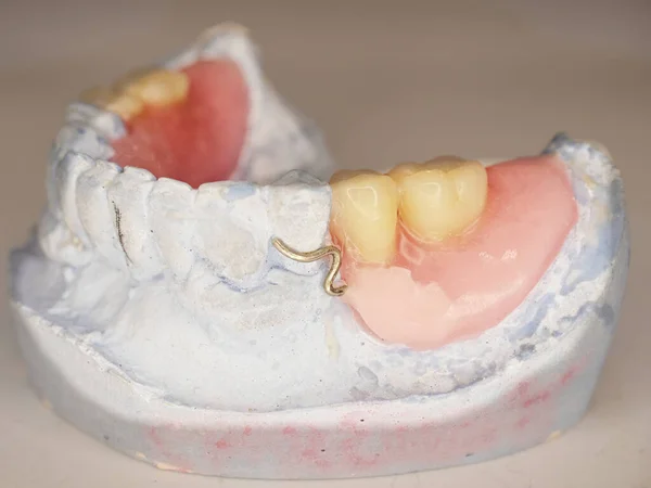 Artificial dental prothesis. Model of human teeth. Cast of teeth with removable partial denture on a dark wooden background.