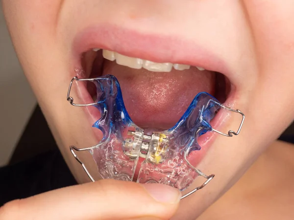 Lustiger Lächelnder Teenager Mit Kieferorthopädie Zahnspange Und Zunge Zähne Mit — Stockfoto