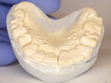 Elindeki alçı diş kalıbı. Diş teknisyeninin elinde insan çenesinin alçı modeli.