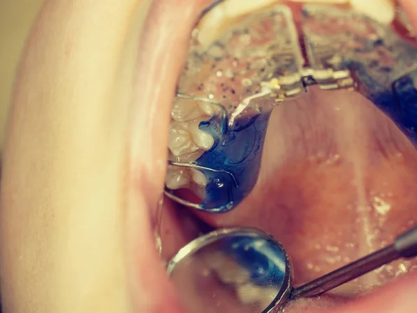 Adolescente Com Aparelho Nos Dentes Macro Tiro Dentes Com Aparelho — Fotografia de Stock