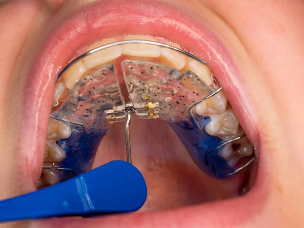 Dentista Verificar Dentes Com Suportes Expansor Usando Ferramentas Dentárias Sonda — Fotografia de Stock
