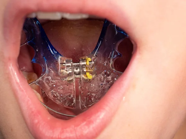 Blaue Zahnspangen Mund Von Kindern Abnehmbares Kieferorthopädisches Gerät Den Oberkiefer — Stockfoto