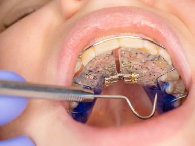 Tam ayarlama için merkezi vida ile beyaz mavi diş telleri ile çocukların ağzına bak.