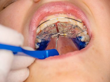 Doctor setting  with tool of Hyrax Expander RPE, Especial palatal braces for correction of birth defect. clipart