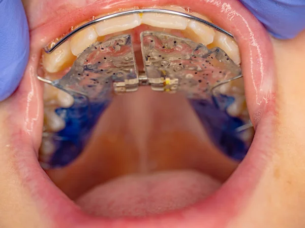 Boca Aberta Menino Cadeira Dentista Enquanto Ortodontista Segura Espelho Seus — Fotografia de Stock