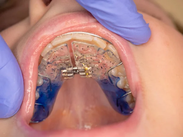 Tratamento Dentário Aparelhos Ajustáveis Nos Dentes Tratamento Ortodôntico Processo Instalação — Fotografia de Stock
