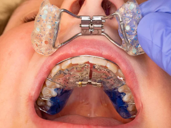 Dentista Trabaja Con Aparatos Ortopédicos Boca Los Niños Con Deformación — Foto de Stock