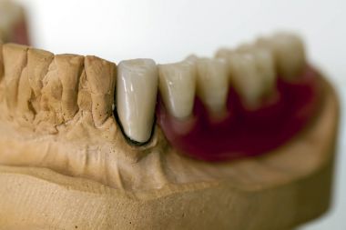 Zirkonyum porselen diş plaka dişçi mağaza